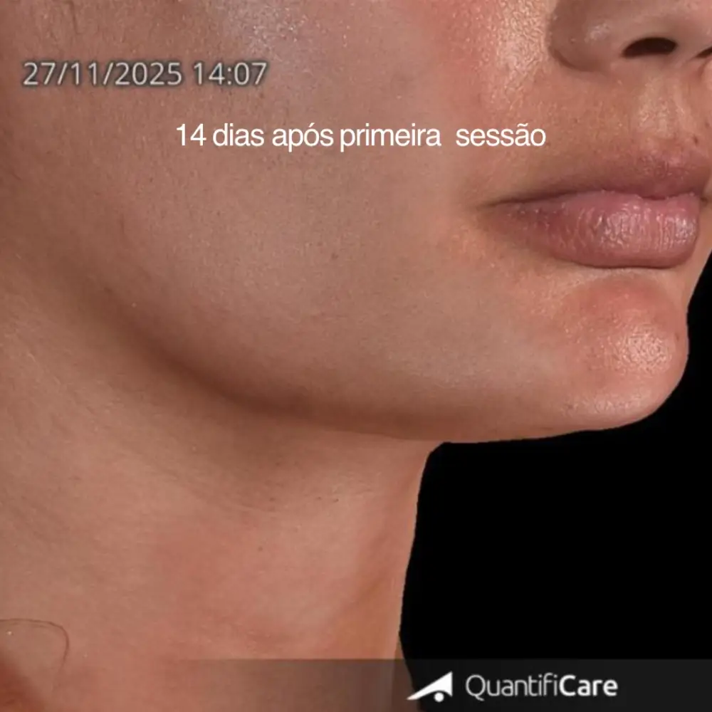 Depois